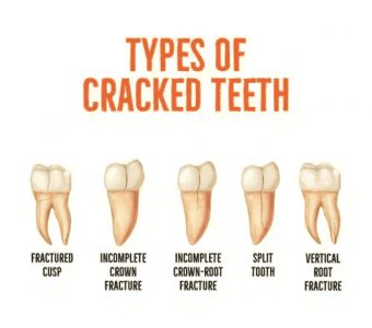 5 Types of Tooth Cracks