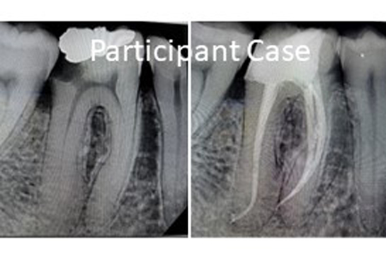 root canal treatment course