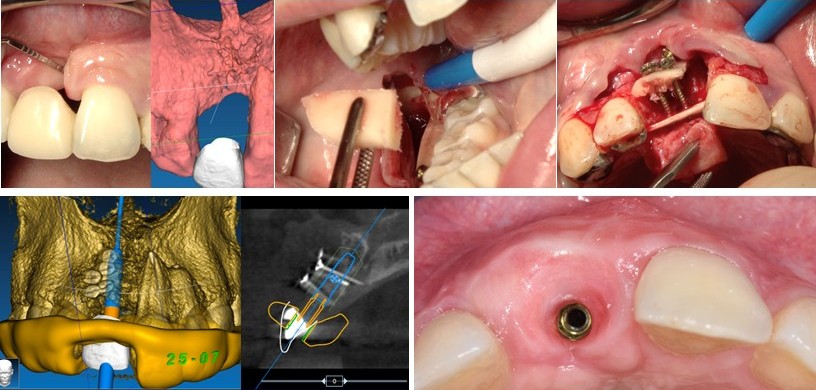 anterior graft collage
