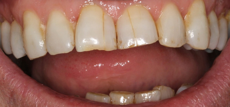 craze lines on front teeth 20201115