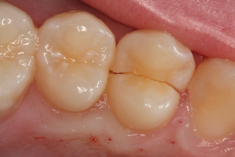 split tooth