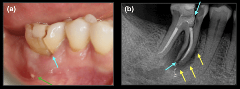 vertical root fracture 4 768x284 1