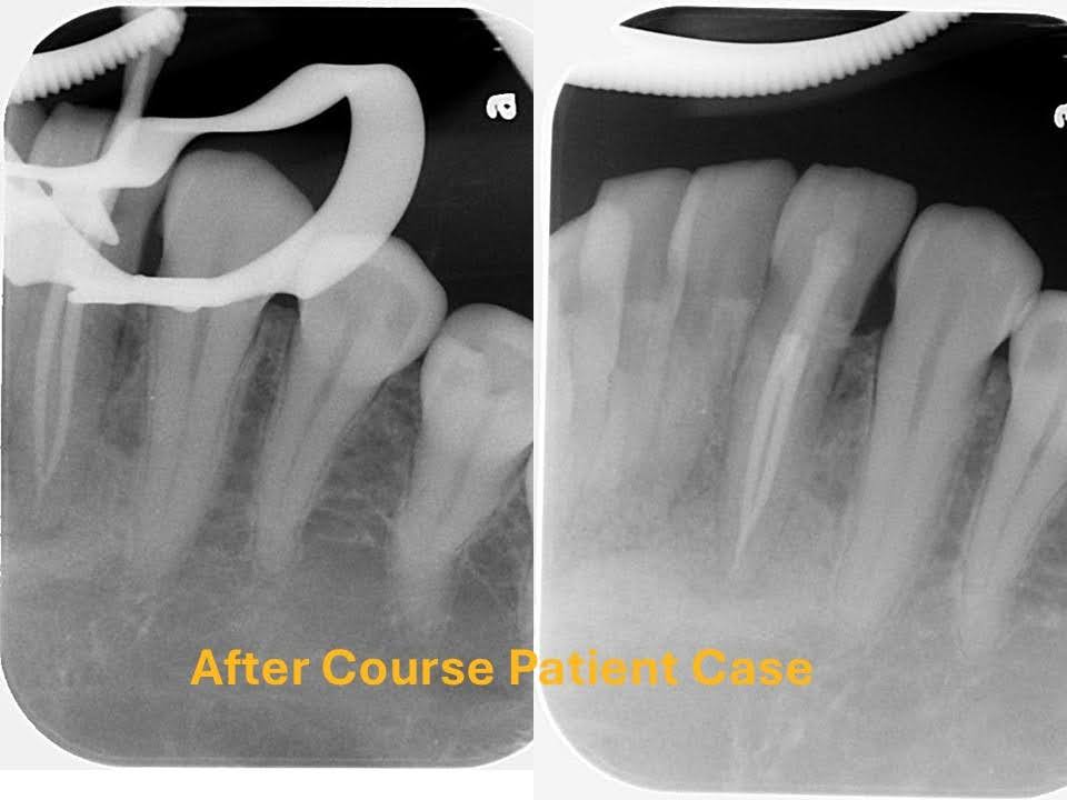 Case Selection Criteria for Apical Microsurgery