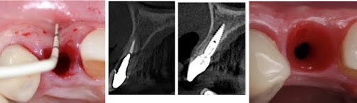 Immediate Implants Course