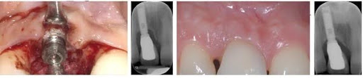 Periodontal Regeneration Hands on