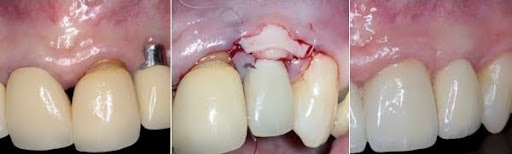Plastic Periodontal Surgery Course