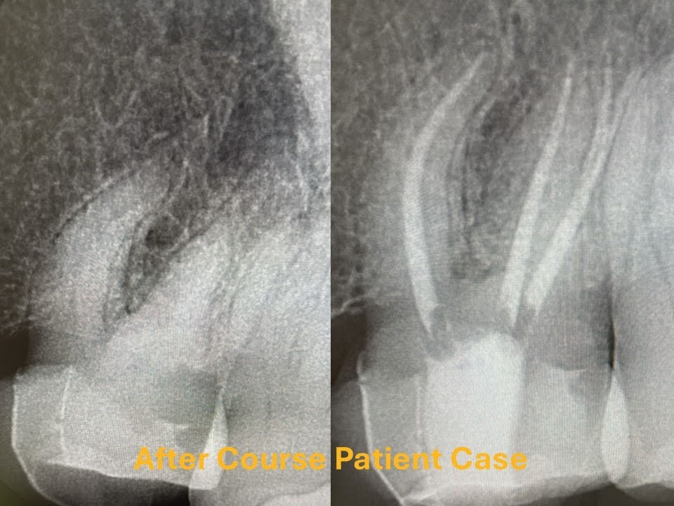 Step by Step Workflow in Modern Apical Surgery