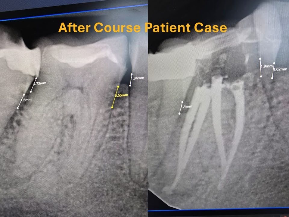 The Step by Step Process of Reopening and Correcting Previous Treatment