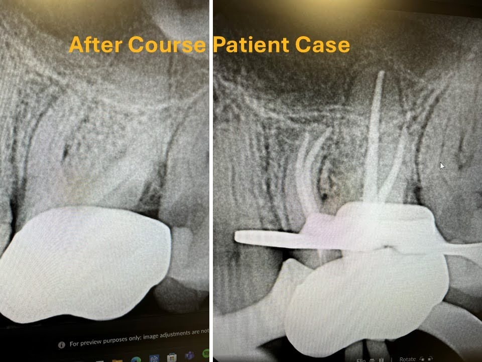 What Patients Can Expect During and After the Procedure