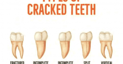 5 Types of Tooth Cracks