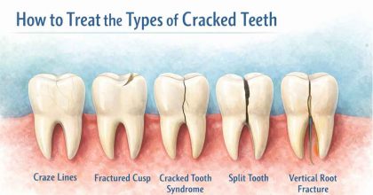 how to treat cracked teeth